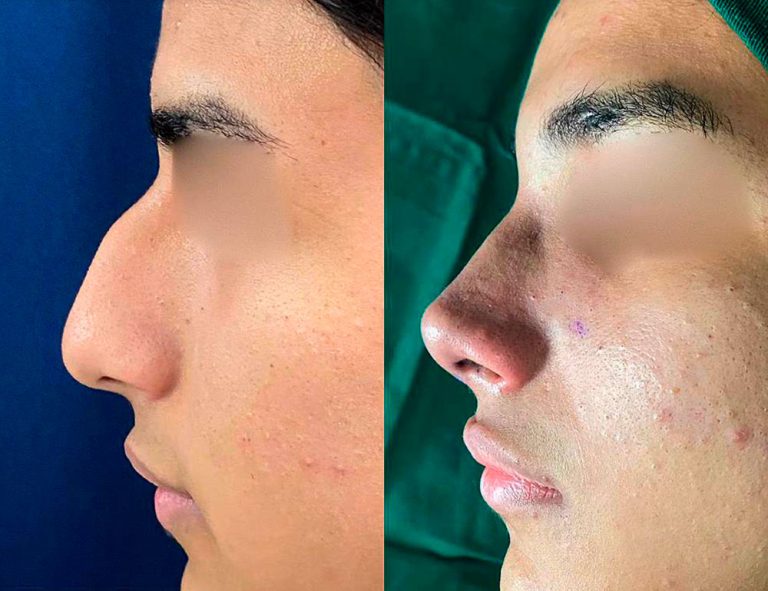 Rinoplastia (post-cirugía)