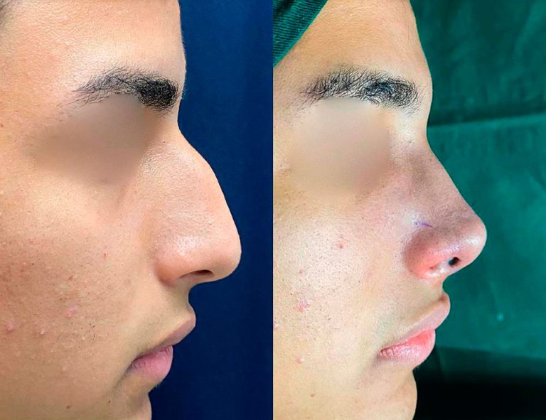 Rinoplastia (post-cirugía)