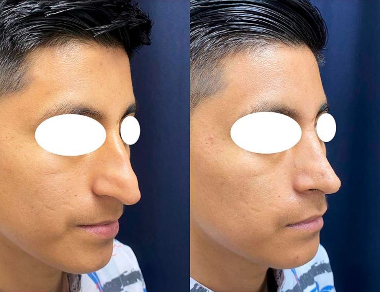 Rinoplastia (30 días)