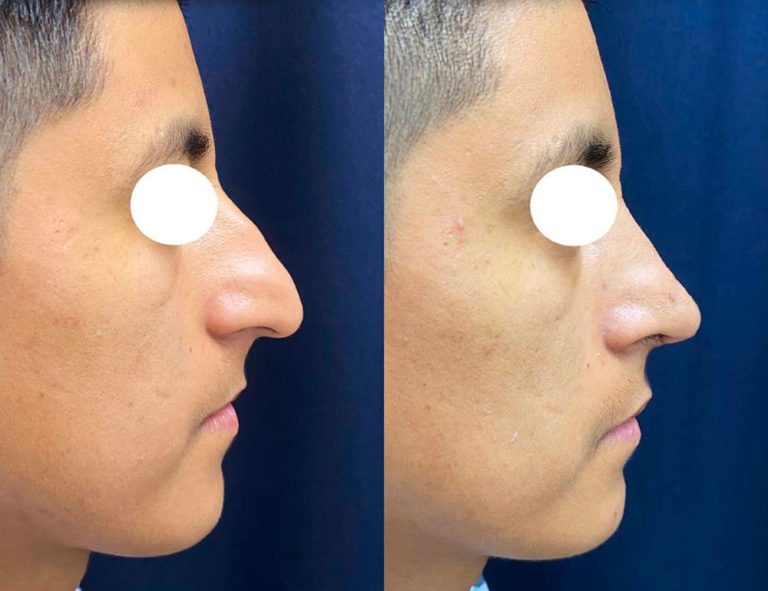 Rinoplastia (30 días)