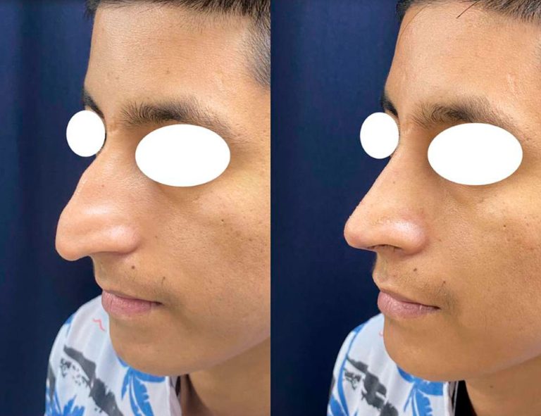 Rinoplastia (30 días)