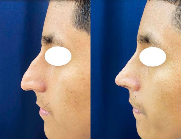 Rinoplastia (30 días)
