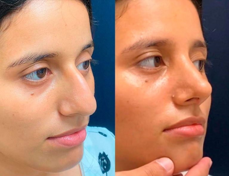 Rinoplastia (2 semanas)