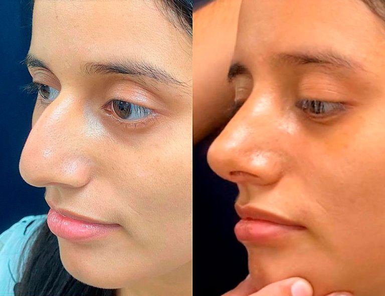 Rinoplastia (2 semanas)