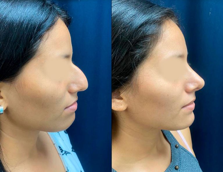 Rinoplastia (40 días)