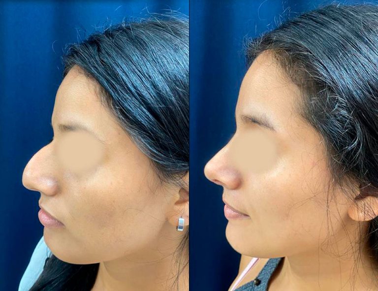 Rinoplastia (40 días)