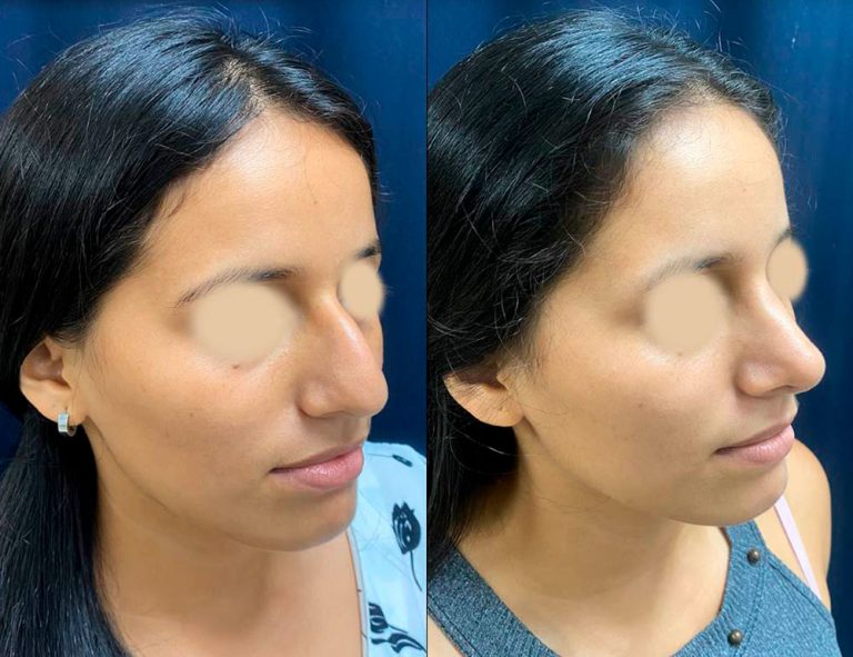 Rinoplastia (40 días)