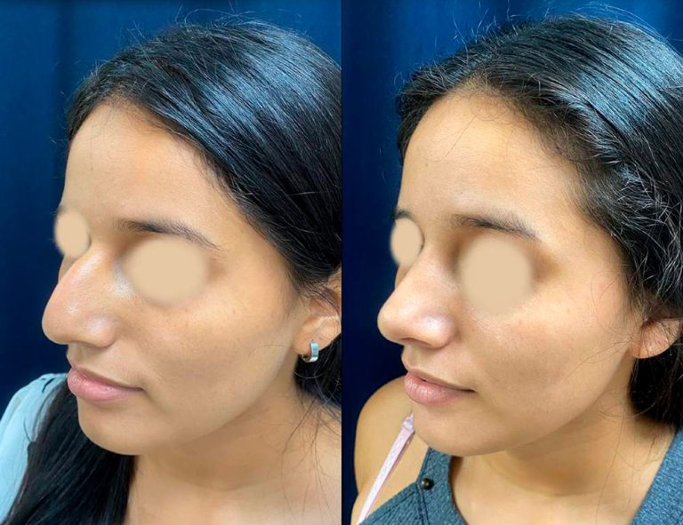 Rinoplastia (40 días)