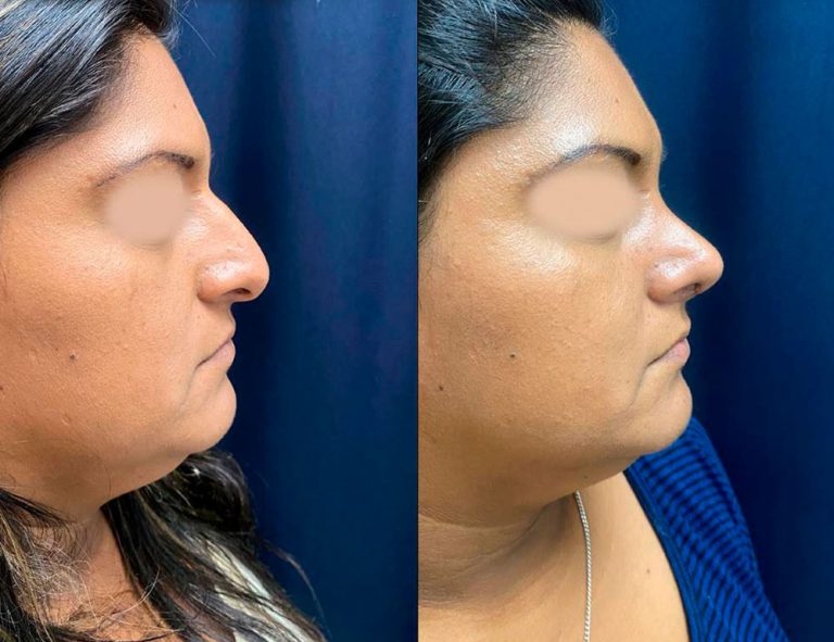 Rinoplastia (40 días)