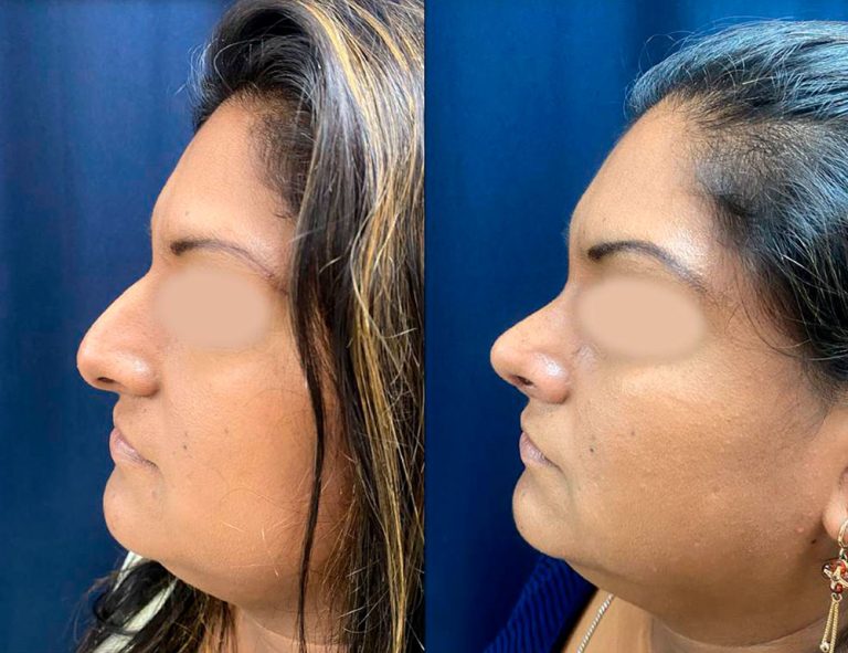 Rinoplastia (40 días)