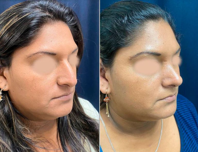 Rinoplastia (40 días)