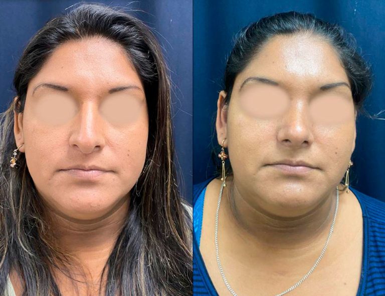 Rinoplastia (40 días)