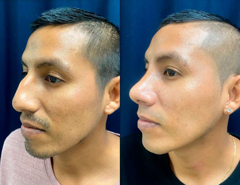 Rinoplastia (40 días)