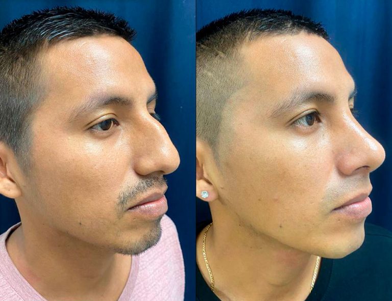 Rinoplastia (40 días)