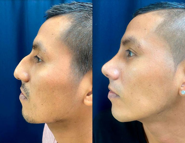 Rinoplastia (40 días)