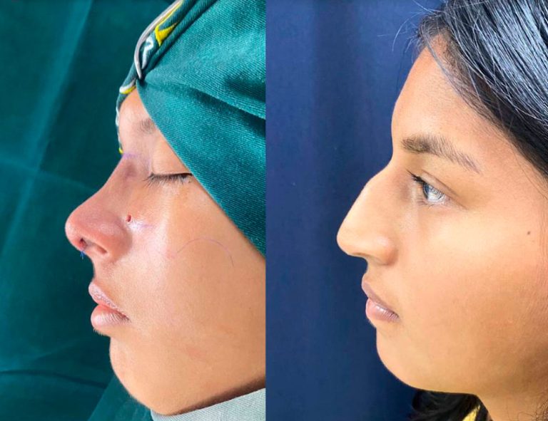 Rinoplastia Láser