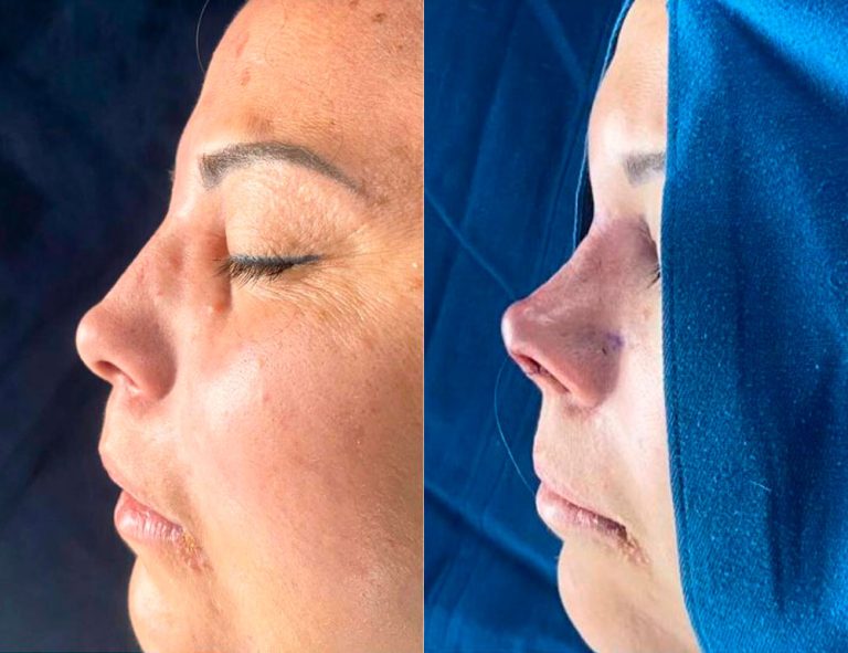 Antes y después de la cirugía