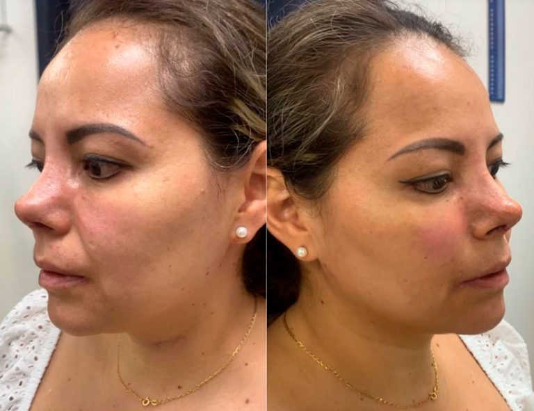 Post-operatorio (7 días)