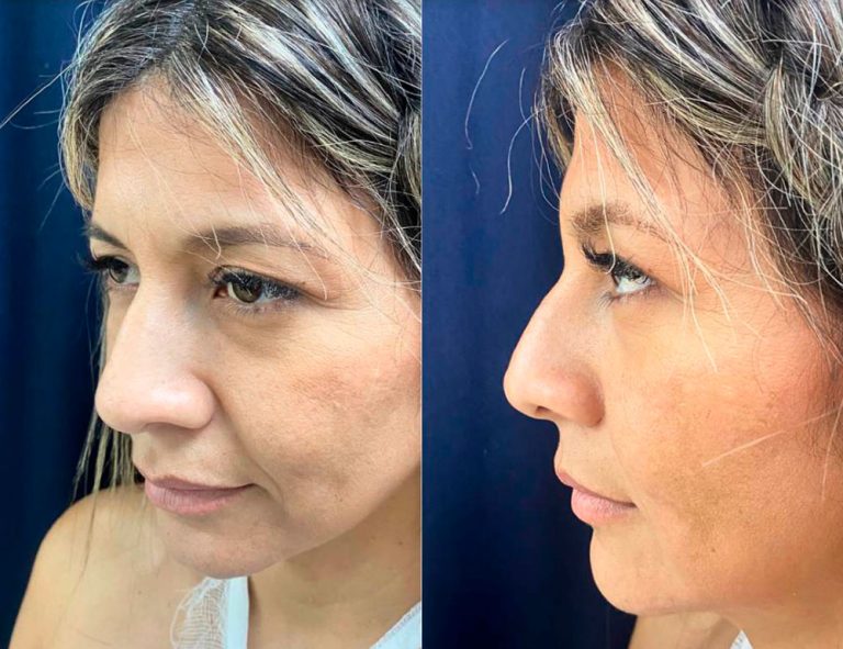 Antes de la cirugía