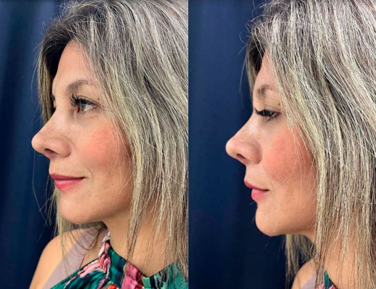 Post-operatorio (15 días)