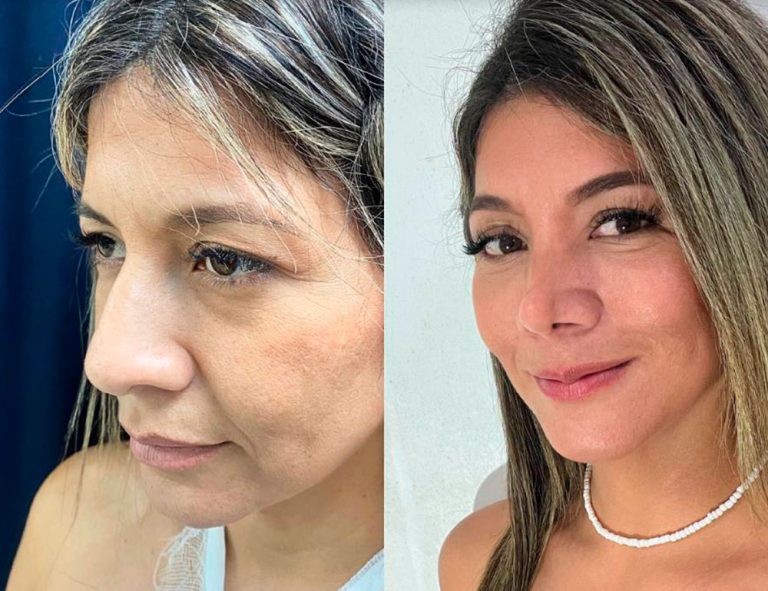 Post-operatorio (2 meses)