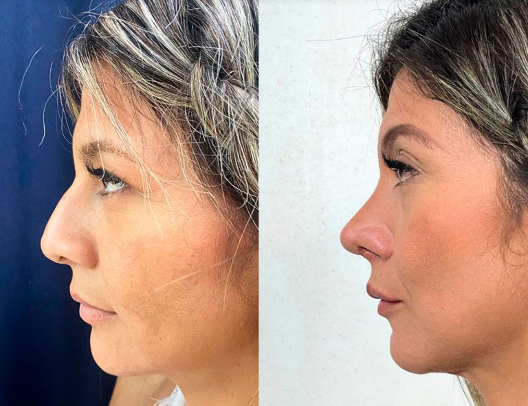 Post-operatorio (2 meses)