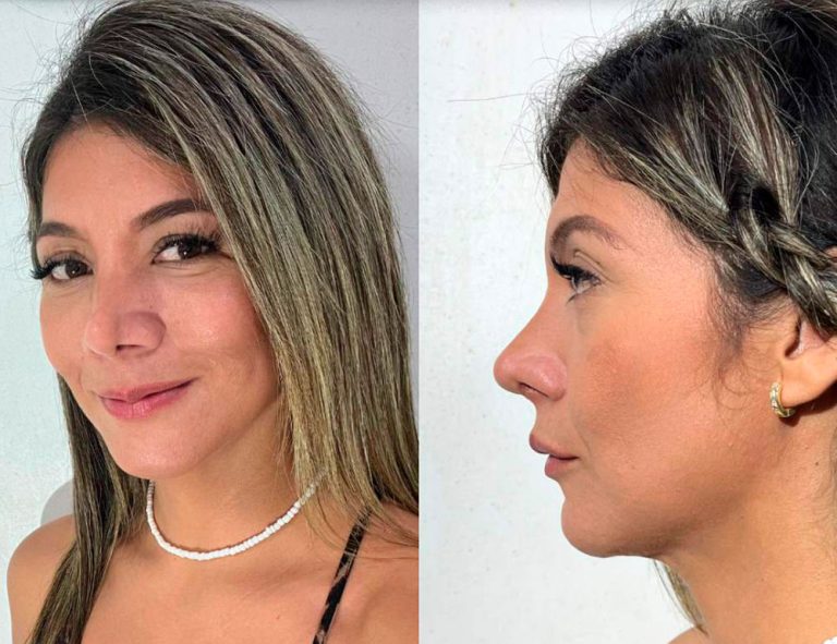 Post-operatorio (2 meses)