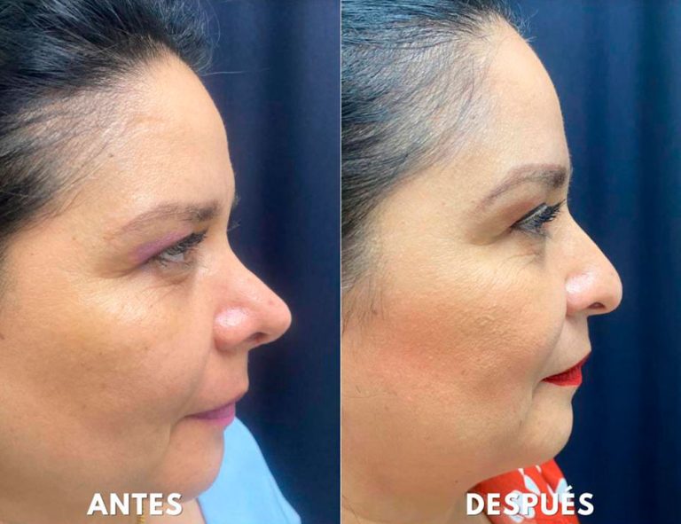 Post-operatorio (2 meses)