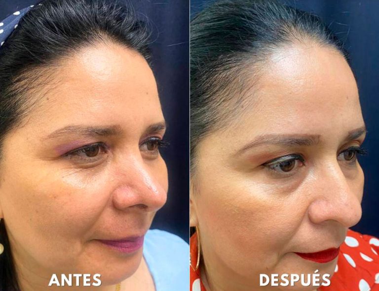 Post-operatorio (2 meses)