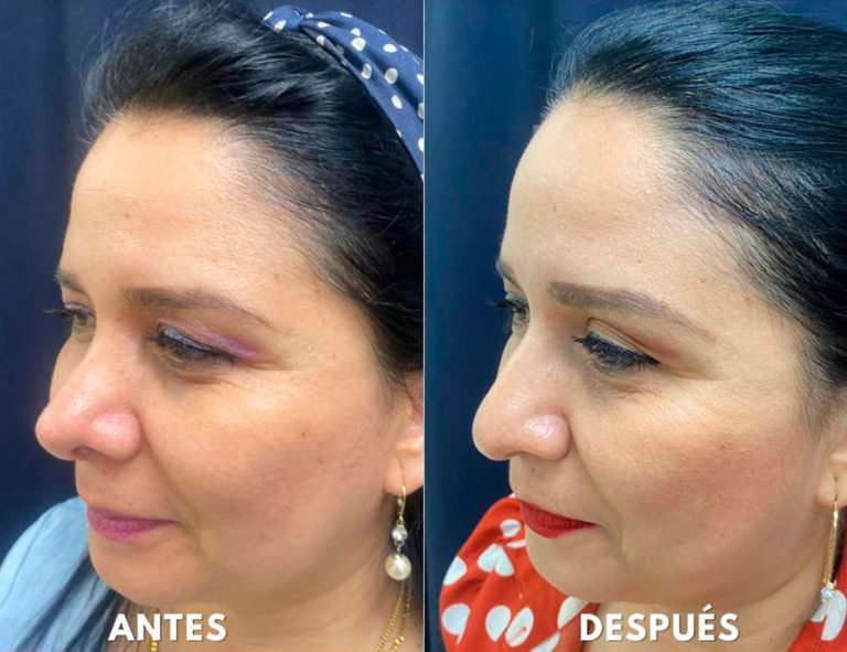 Post-operatorio (2 meses)