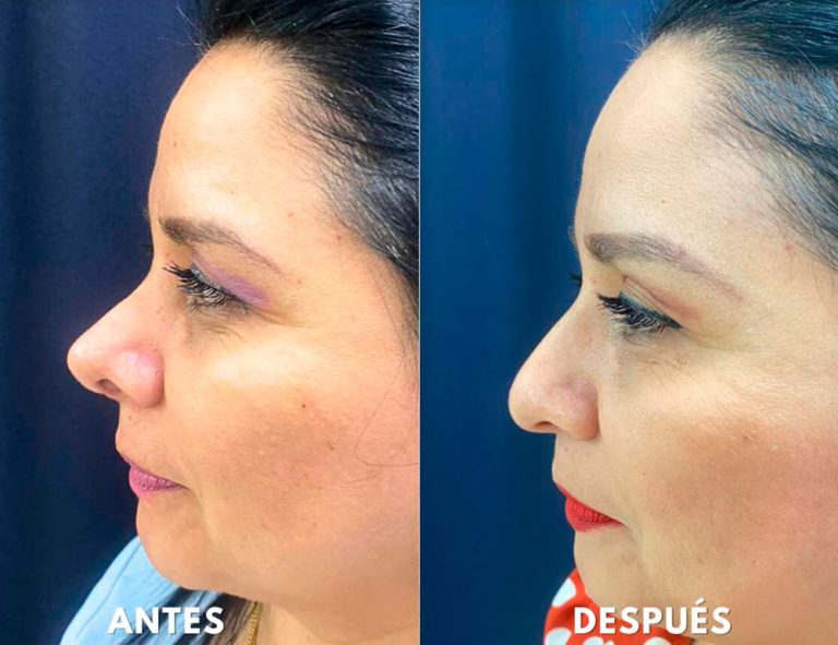 Post-operatorio (2 meses)