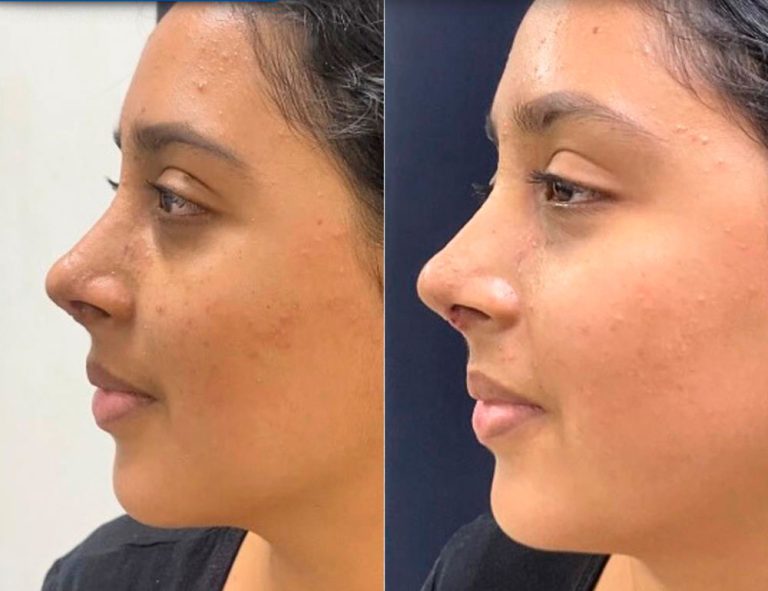 Post-operatorio (2 semanas)