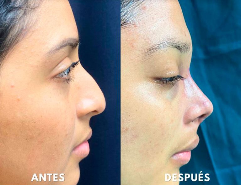 Post-operatorio inmediato