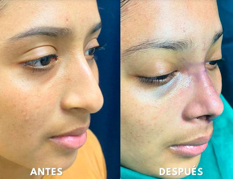 Post-operatorio inmediato