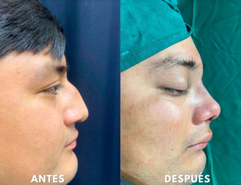 Post-operatorio inmediato