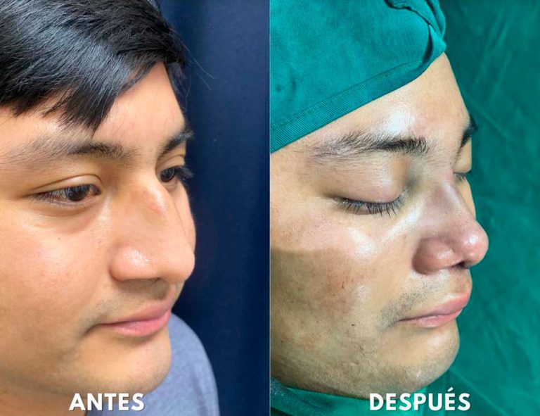 Post-operatorio inmediato