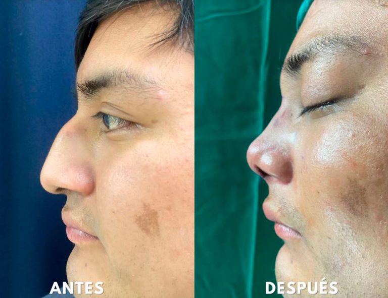 Post-operatorio inmediato