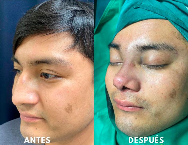 Post-operatorio inmediato