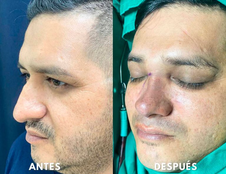 Post-operatorio inmediato