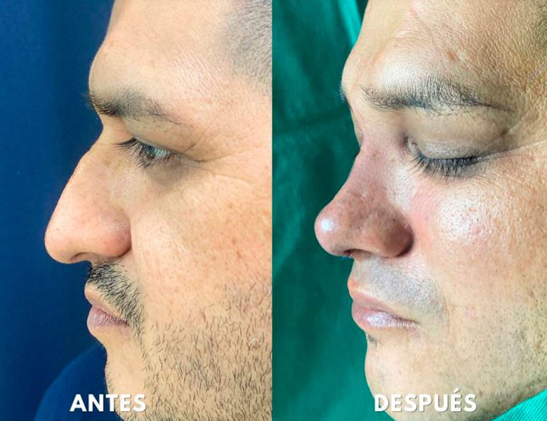 Post-operatorio inmediato