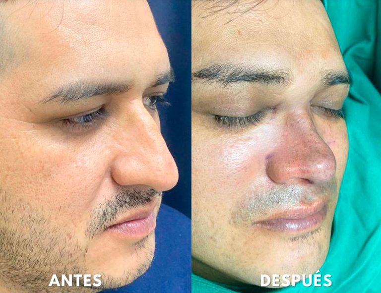 Post-operatorio inmediato