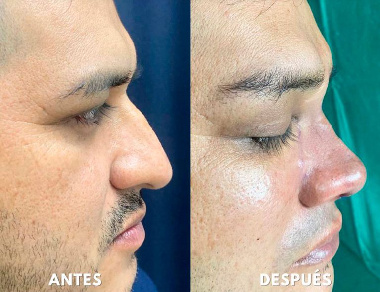 Post-operatorio inmediato