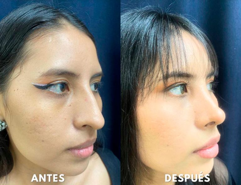 Post-operatorio (40 días)