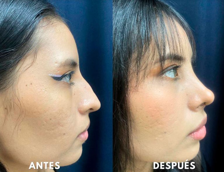 Post-operatorio (40 días)