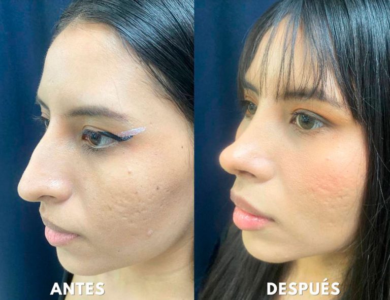 Post-operatorio (40 días)