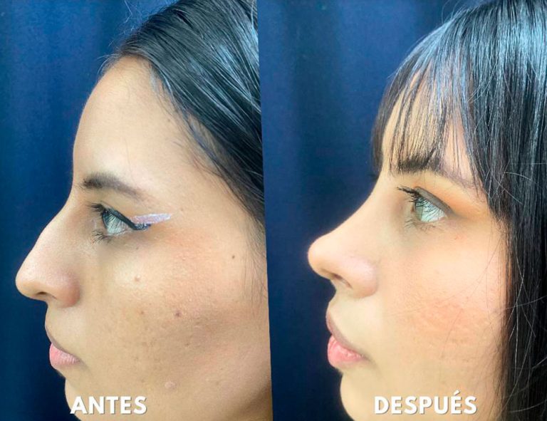 Post-operatorio (40 días)