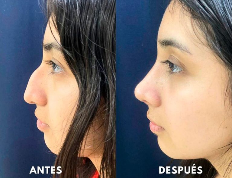 Post-operatorio (40 días)