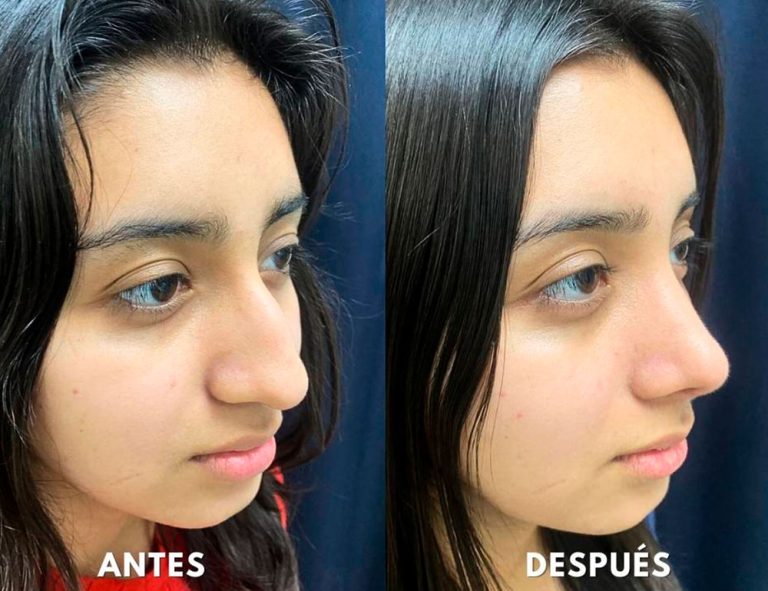 Post-operatorio (40 días)