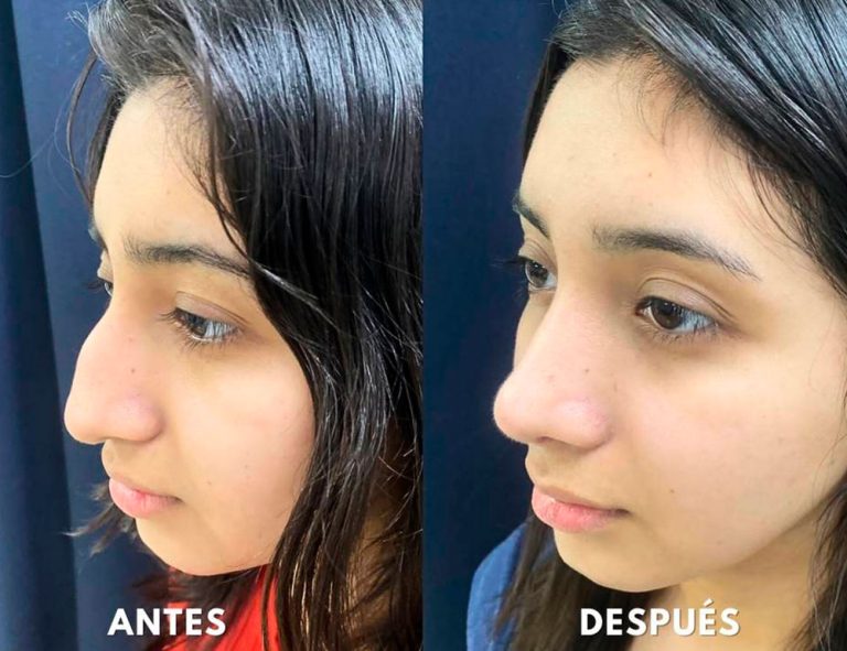 Post-operatorio (40 días)