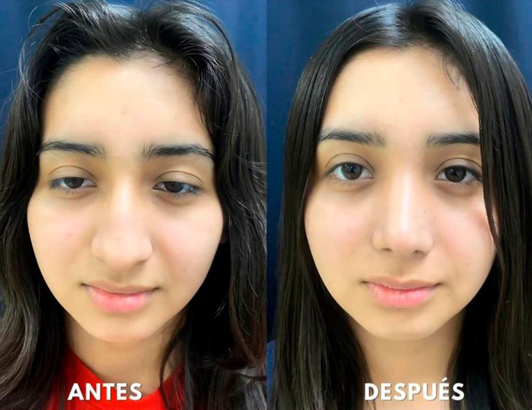 Post-operatorio (40 días)